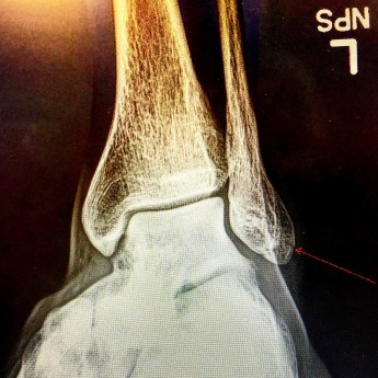 The little "you are here" arrow added by my radiologist points to the problem.